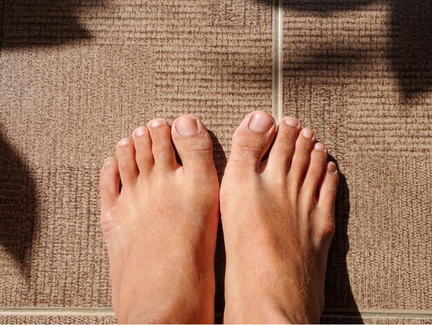 拇指外翻, Bunion, HV, hallus valgus